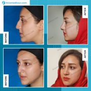 Rhinoplasty In Iran Best Surgeons Hospitals Ariamedtour