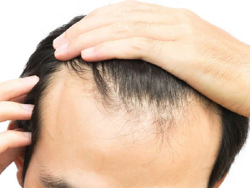 مشكلة تساقط الشعر عند الرجال