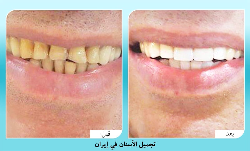 صور قبل وبعد تجميل وتبييض الاسنان في ايران د. أمير حسين سربازي