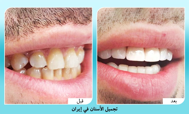 صورة قبل وبعد تجميل وتبييض الاسنان في ايران