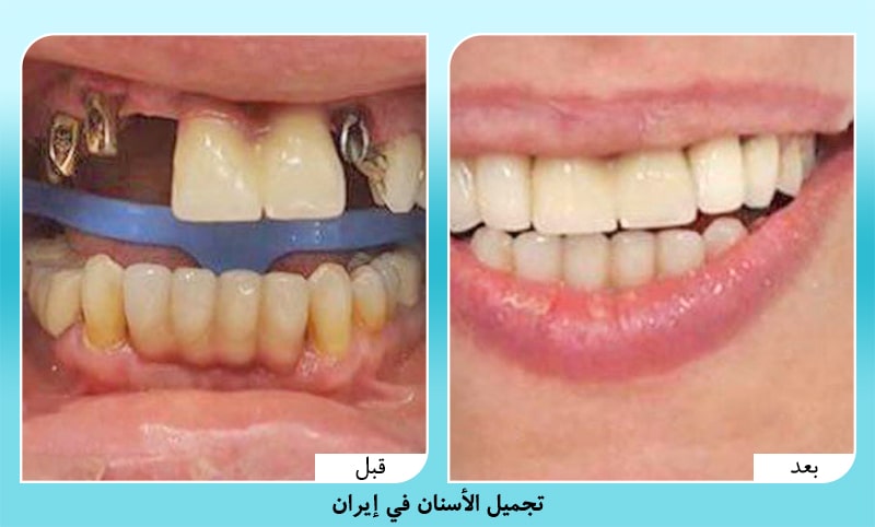 صورة قبل وبعد تجميل وتعويض الاسنان في ايران د. أمير حسين سربازي