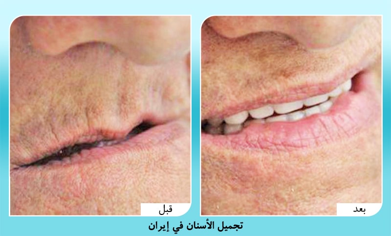 تعويض الاسنان في ايران د. أمير حسين سربازي