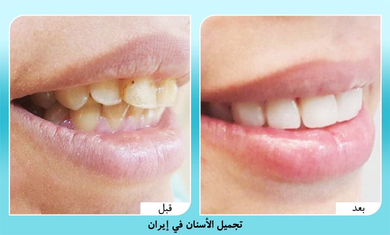 تبييض وتجميل الاسنان في ايران د. أمير حسين سربازي