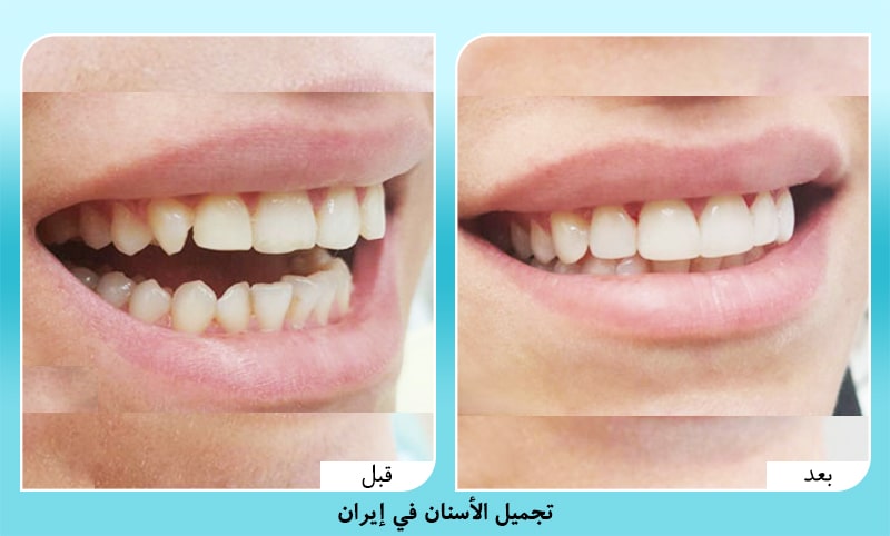 قبل وبعد تجميل الاسنان في ايران د. أمير حسين سربازي
