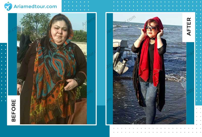 جراحة انقاص الوزن في ايران مع د. شهريار عزيزي