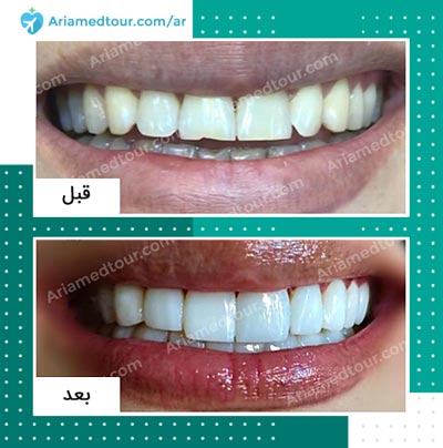 قبل وبعد علاج و تجميل الاسنان في ايران
