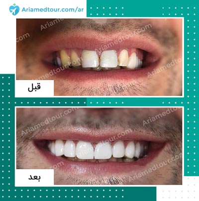 قبل وبعد علاج و تجميل الاسنان في ايران