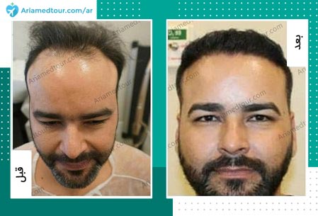 قبل وبعد زراعة الشعر في ايران