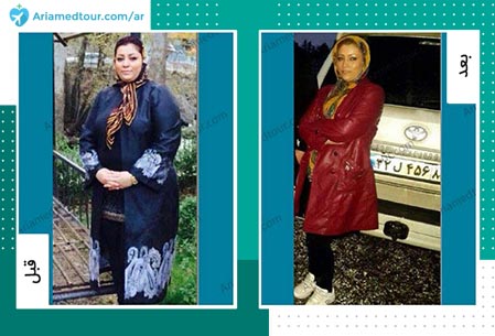 قبل و بعد جراحة انقاص الوزن في ايران