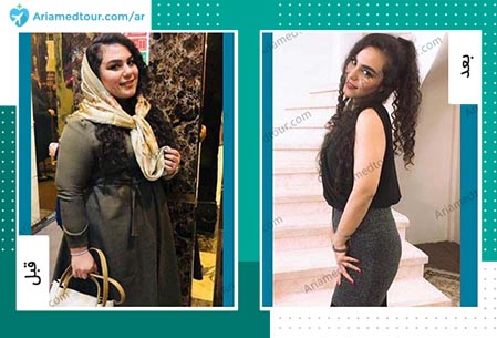 قبل و بعد جراحة انقاص الوزن في ايران