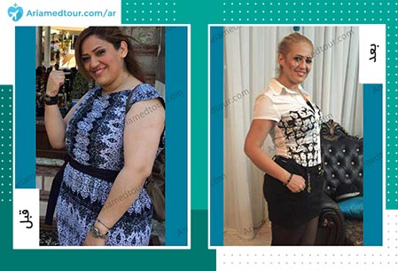 قبل و بعد عملية انقاص الوزن في ايران