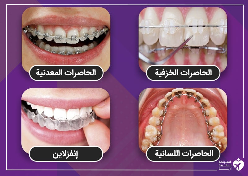 4 أنواع مختلفة من تقويم الأسنان
