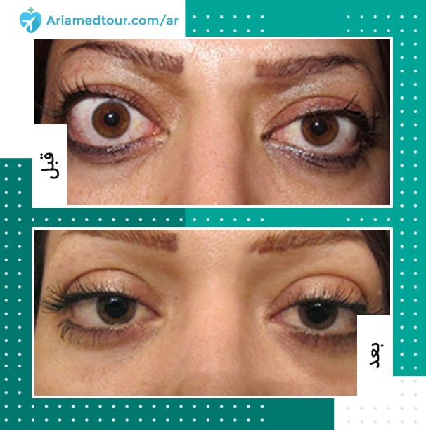 عيون المرأة بعد علاج جحوظ العين