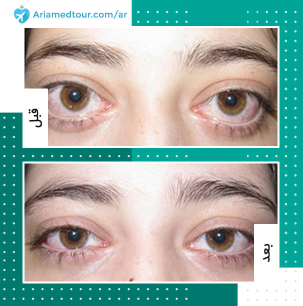 عيون المرأة بعد جراحة جحوظ العيون