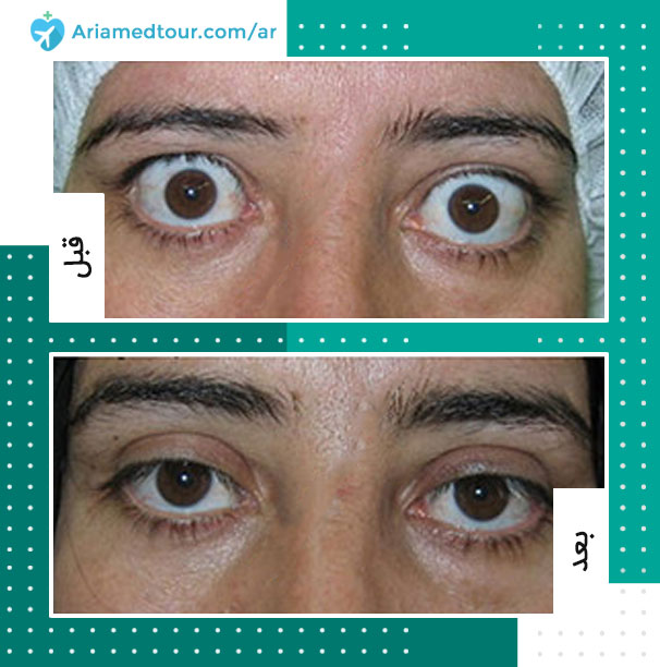 عيون المرأة بعد جراحة جحوظ