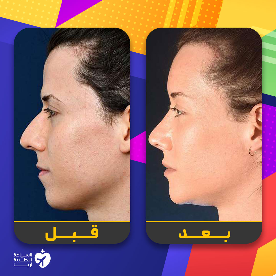 امرأة قبل وبعد جراحة تأنيث الوجه