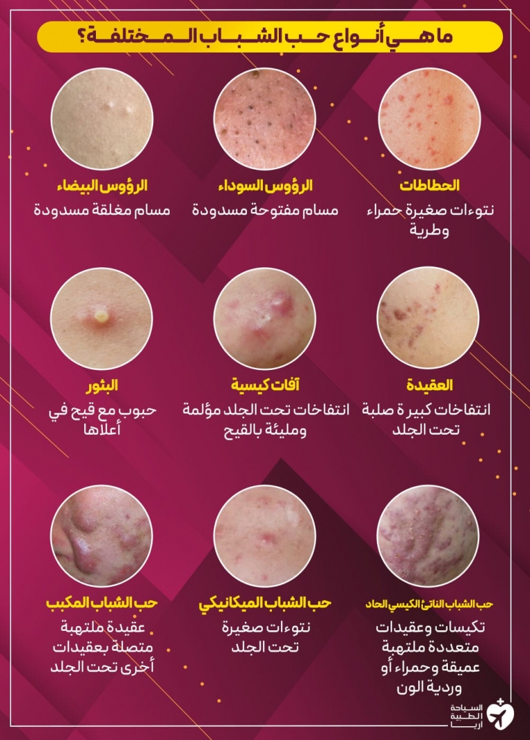 15 طريقة للتخلص من حب الشباب دون عمليات تجميل آریامدتور 0227