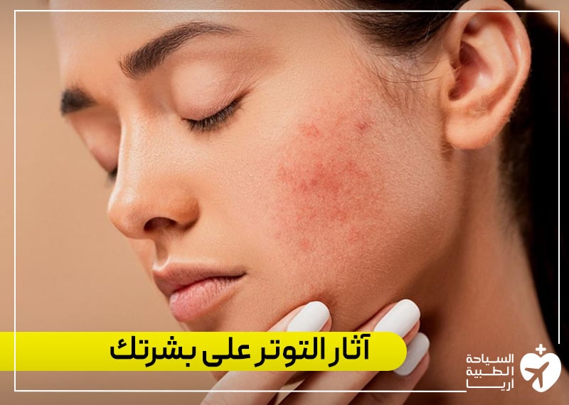 آثار التوتر على بشرتك