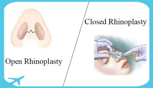 رینوپلاستی بسته- جراحی بینی باز