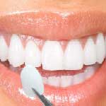 طب دندان، ستوماتولوژِی، روکش دندان(وینر دندان) در ایران