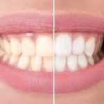 سفید کردن دندان در ایران