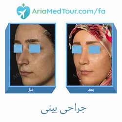 جراحی زیبایی بینی در ایران