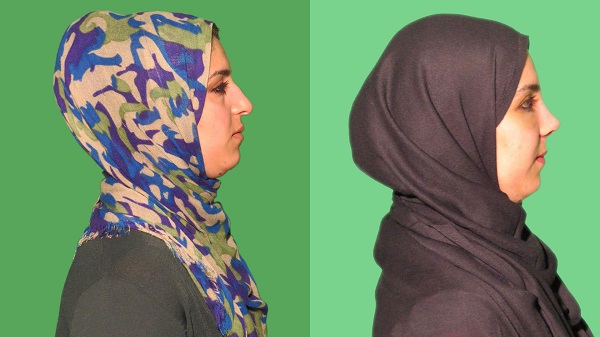 عکس قبل و بعد جراحی زیبایی بینی