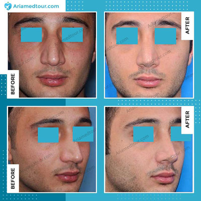 rhinoplasty nose job before after photo in iran