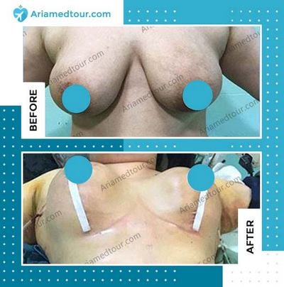 breast augmentation before and after photo in Iran