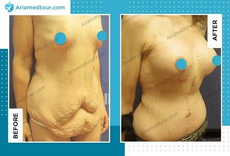 breast augmentation before and after photo in Iran