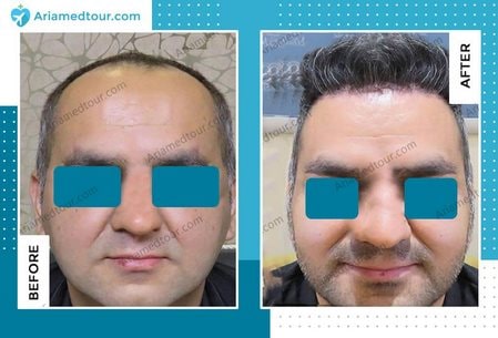 hair transplant before after Iran