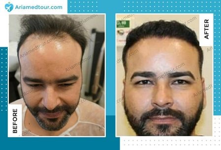 hair transplant before after photo Iran