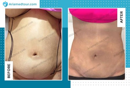 liposuction before and after in Iran