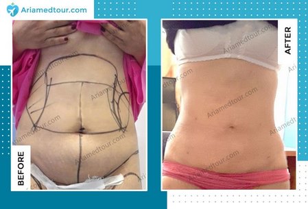 liposuction before and after in Iran