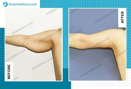 arm lift before after photo in iran