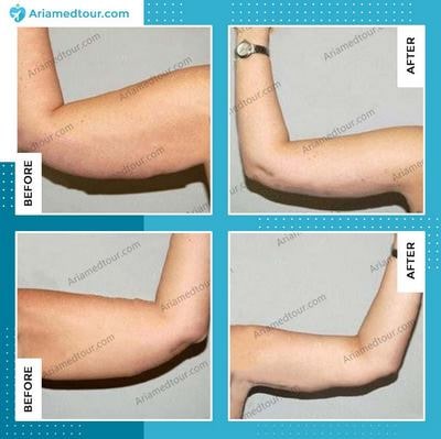 brachioplasty arm lift before after photo in iran