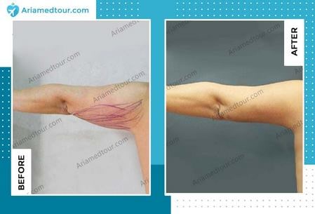 arm lift before after photo
