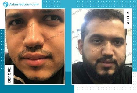beard transplant in Iran before after photo