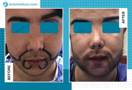 beard transplant before after photo in Iran