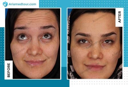 Botox before and after photo