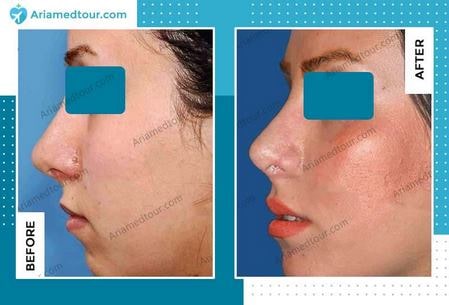 cheek augmentation before and after in Iran