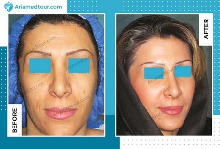 cheek augmentation in Iran before after