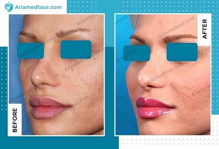 cheek augmentation surgery in Iran before after