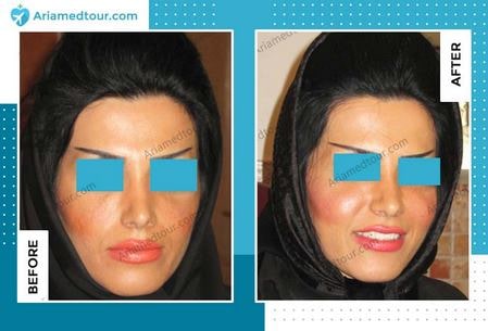 cheek augmentation surgery before after in Iran