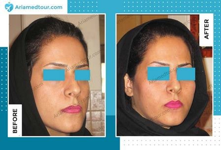 cheek augmentation surgery before after in Iran