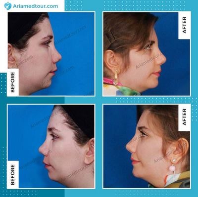 chin augmentation before after