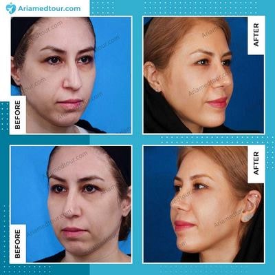 chin augmentation before after photo in Iran