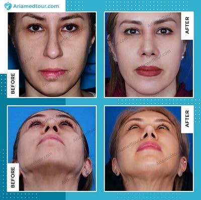 chin augmentation before after in Iran