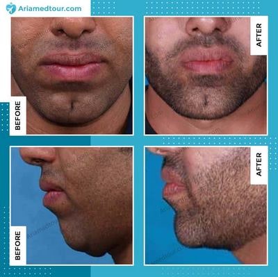 chin augmentation surgery before after in Iran