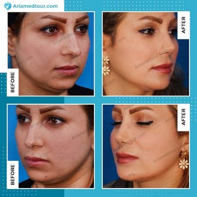 chin augmentation in Iran before after